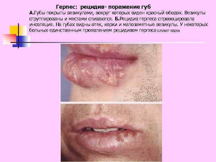 Герпес: рецидив- поражение губ А. Губы покрыты везикулами, вокруг которых виден красный ободок. Везикулы
