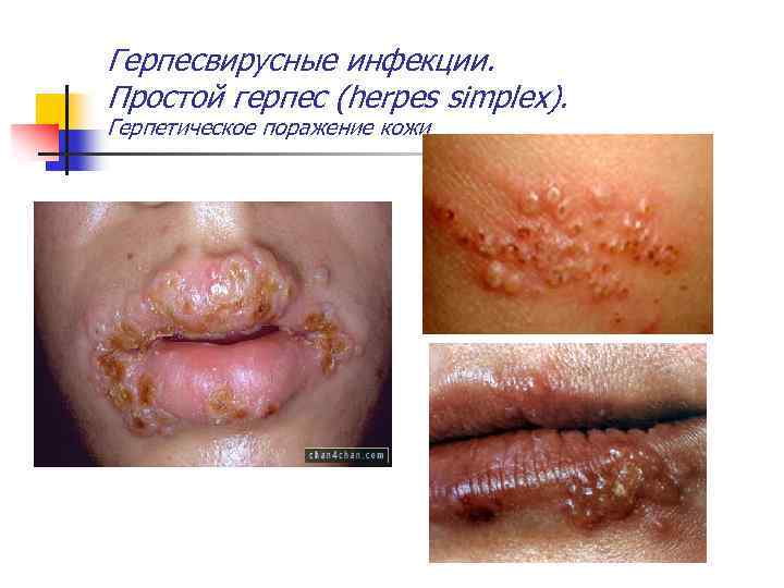 Герпесвирусные инфекции. Простой герпес (herpes simplex). Герпетическое поражение кожи 