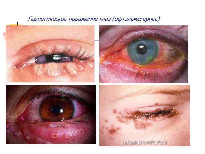 Герпетическое поражение глаз (офтальмогерпес) 