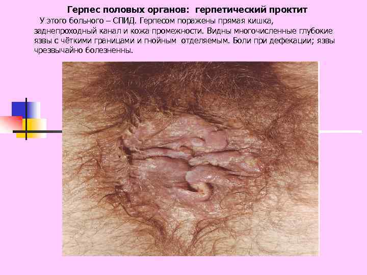 Герпес половых органов: герпетический проктит У этого больного – СПИД. Герпесом поражены прямая кишка,