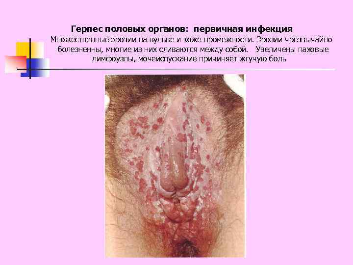 Герпес половых органов: первичная инфекция Множественные эрозии на вульве и коже промежности. Эрозии чрезвычайно