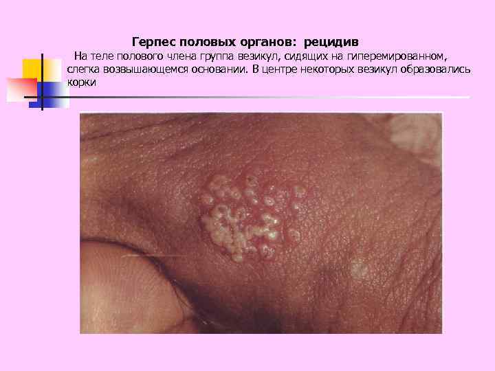 Герпес половых органов: рецидив На теле полового члена группа везикул, сидящих на гиперемированном, слегка