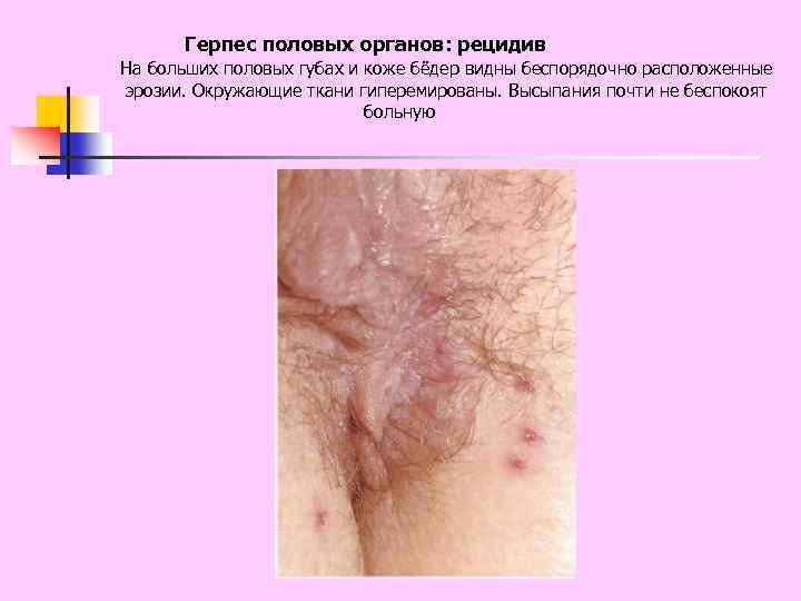 Герпес половых органов: рецидив На больших половых губах и коже бёдер видны беспорядочно расположенные