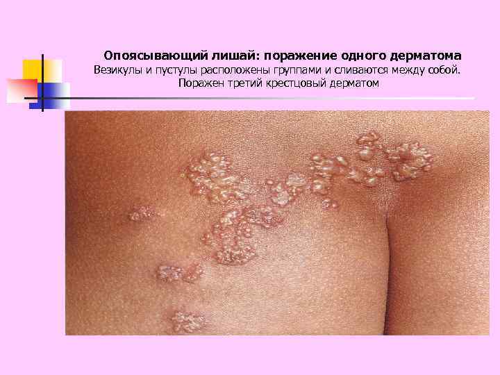 Опоясывающий лишай: поражение одного дерматома Везикулы и пустулы расположены группами и сливаются между собой.