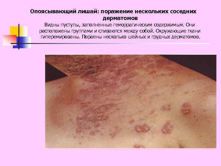 Опоясывающий лишай: поражение нескольких соседних дерматомов Видны пустулы, заполненные геморрагическим содержимым. Они расположены группами
