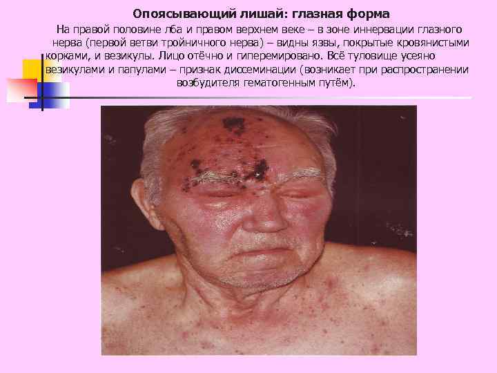 Опоясывающий лишай: глазная форма На правой половине лба и правом верхнем веке – в
