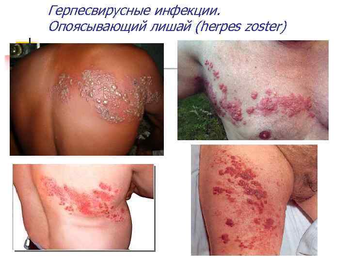 Герпесвирусные инфекции. Опоясывающий лишай (herpes zoster) 