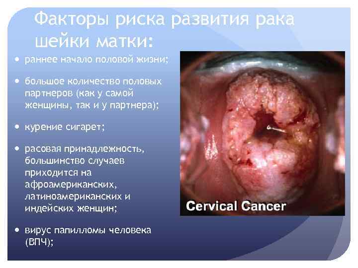Факторы риска развития рака шейки матки: раннее начало половой жизни; большое количество половых партнеров