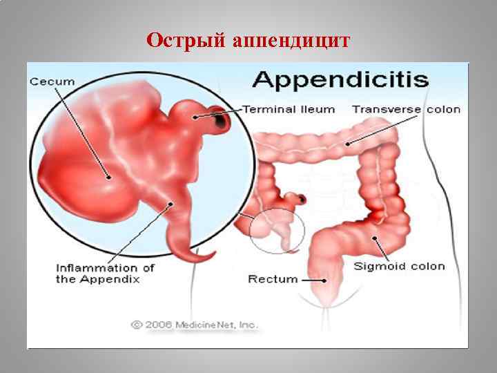 Острый аппендицит 