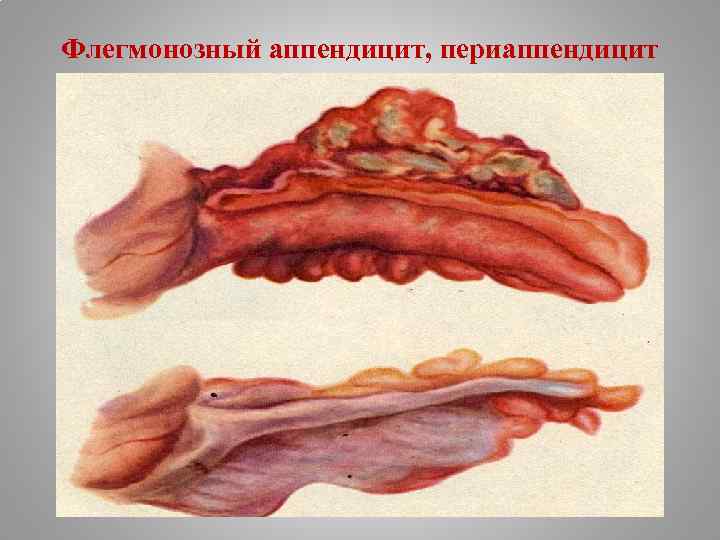 Флегмонозный аппендицит, периаппендицит 