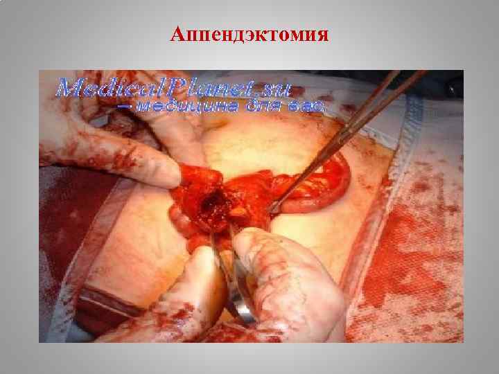 Аппендэктомия 