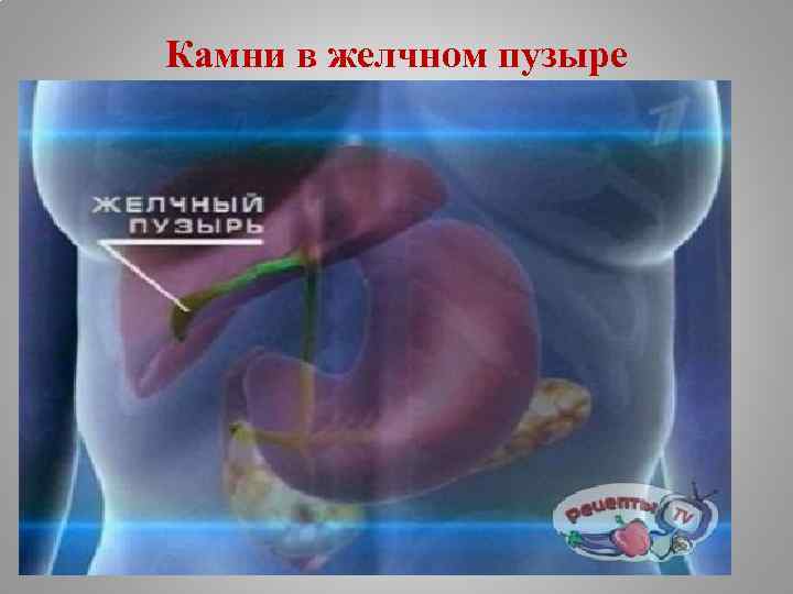 Камни в желчном пузыре 