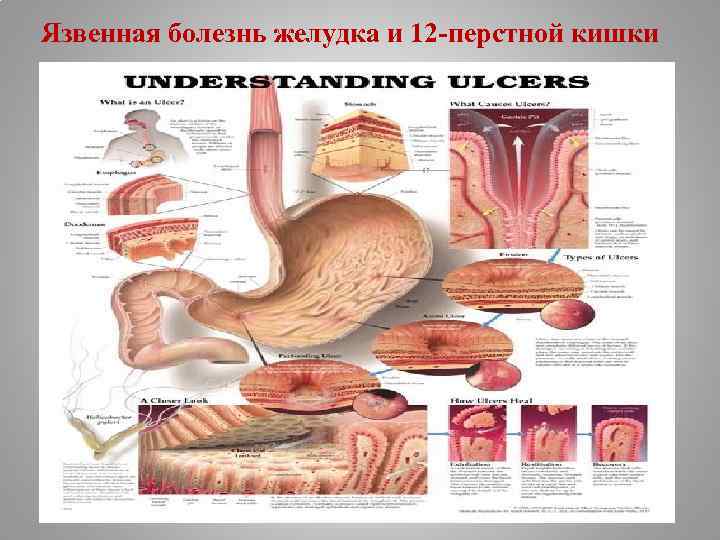 Язвенная болезнь желудка и 12 -перстной кишки 
