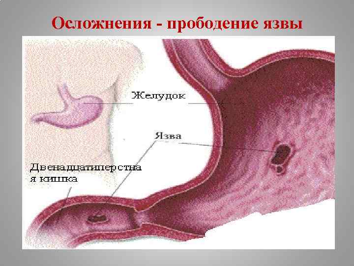 Осложнения - прободение язвы 