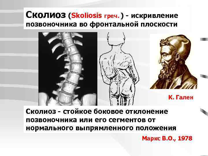 Сколиоз (Skoliosis греч. ) - искривление позвоночника во фронтальной плоскости К. Гален Сколиоз -