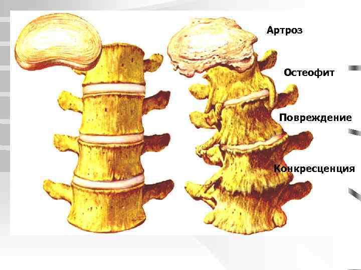 Краевые остеофиты тел позвонков что это такое фото