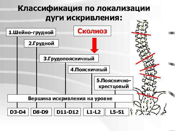 Классификация по локализации дуги искривления: 1. Шейно-грудной Сколиоз 2. Грудной 3. Грудопоясничный 4. Поясничный