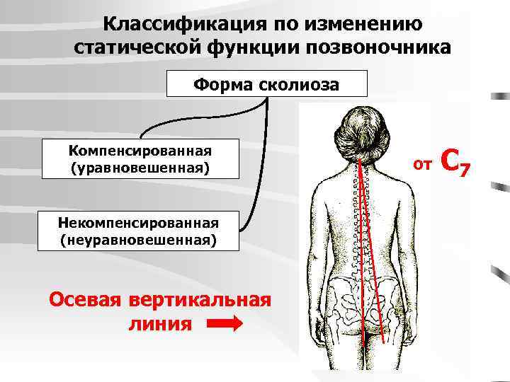 Классификация по изменению статической функции позвоночника Форма сколиоза Компенсированная (уравновешенная) Некомпенсированная (неуравновешенная) Осевая вертикальная