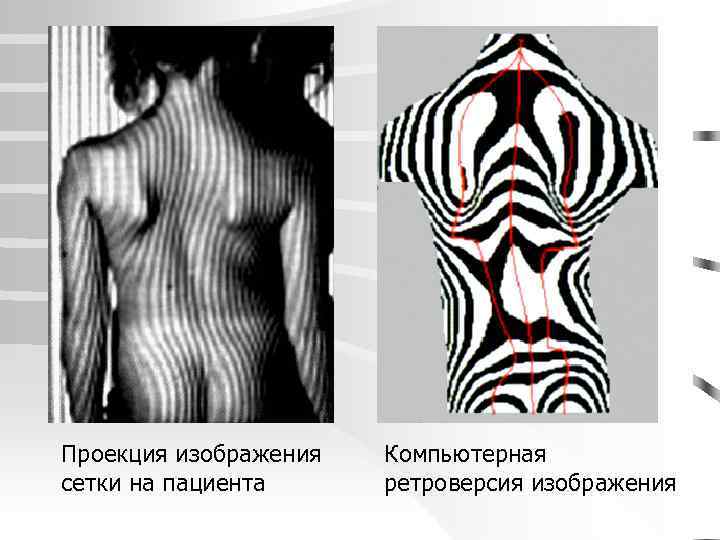 Проекция изображения сетки на пациента Компьютерная ретроверсия изображения 