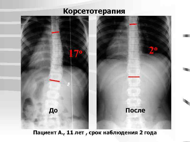 Корсетотерапия 2 о 17 о До После Пациент А. , 11 лет , срок