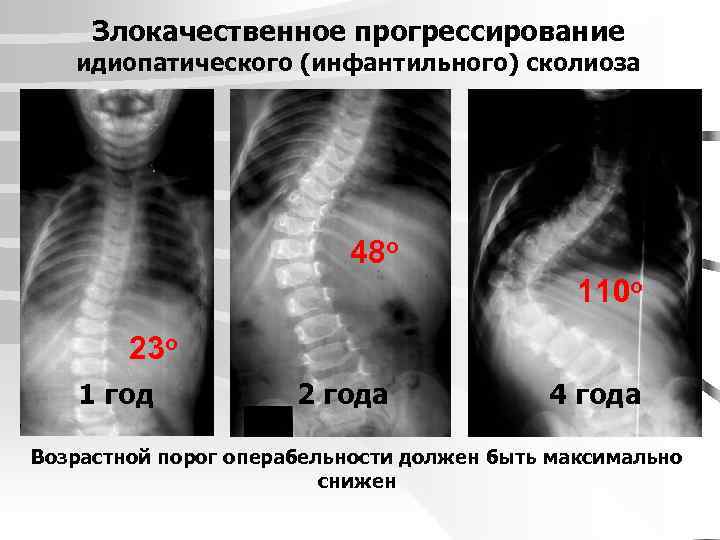 Злокачественное прогрессирование идиопатического (инфантильного) сколиоза 48 o 110 o 23 o 1 год 2