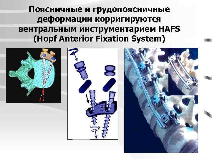 Поясничные и грудопоясничные деформации корригируются вентральным инструментарием HAFS (Hopf Anterior Fixation System) 