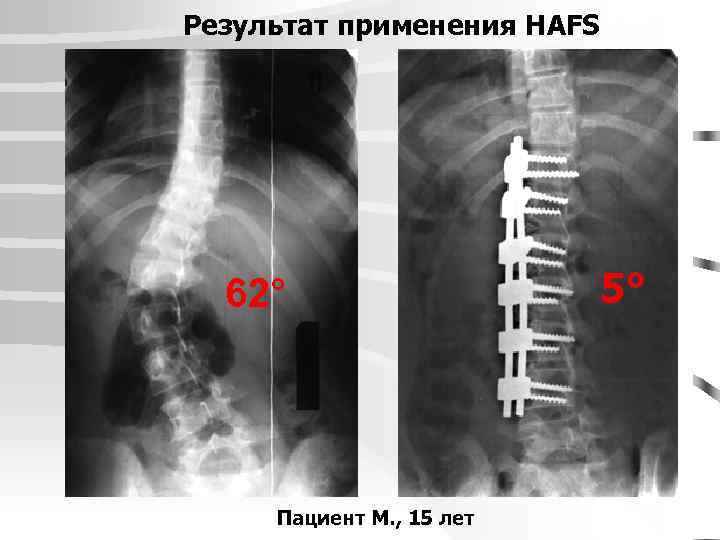 Результат применения HAFS 62° Пациент М. , 15 лет 5° 