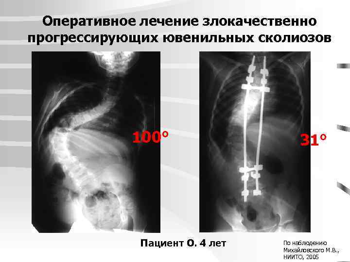 Оперативное лечение злокачественно прогрессирующих ювенильных сколиозов 100° Пациент О. 4 лет 31° По наблюдению