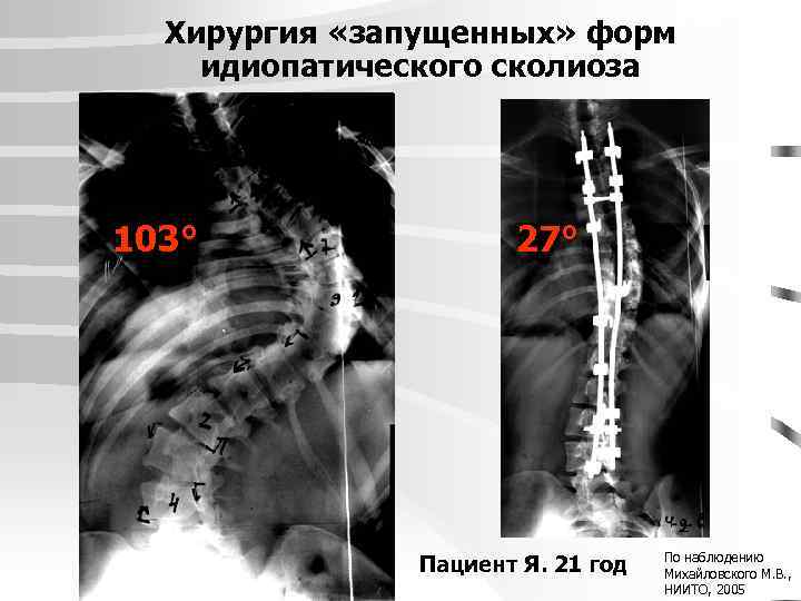 Хирургия «запущенных» форм идиопатического сколиоза 103° 27° Пациент Я. 21 год По наблюдению Михайловского