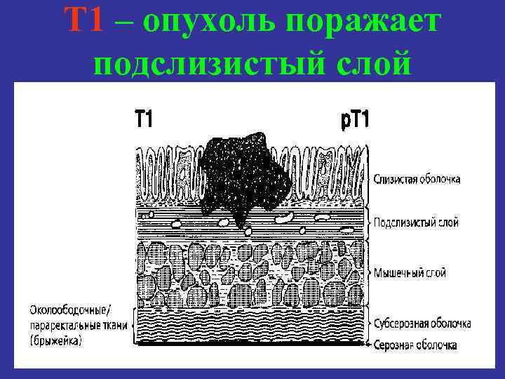 T 1 – опухоль поражает подслизистый слой 