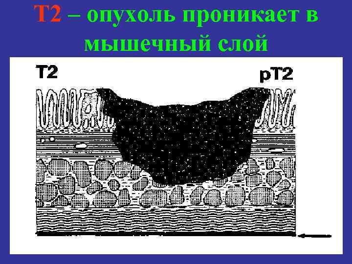 T 2 – опухоль проникает в мышечный слой 