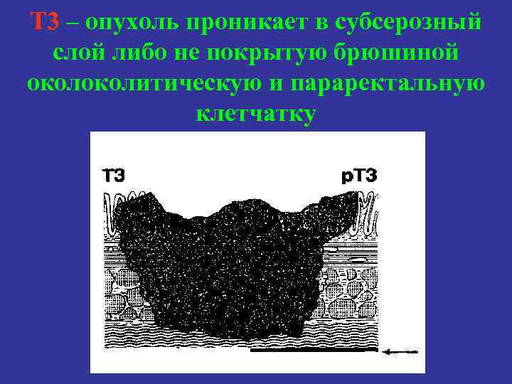 Т 3 – опухоль проникает в субсерозный слой либо не покрытую брюшиной околитическую и