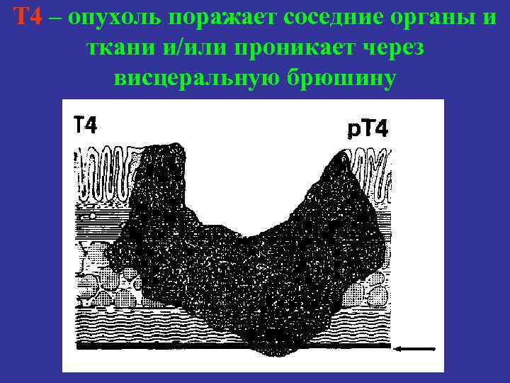 Т 4 – опухоль поражает соседние органы и ткани и/или проникает через висцеральную брюшину