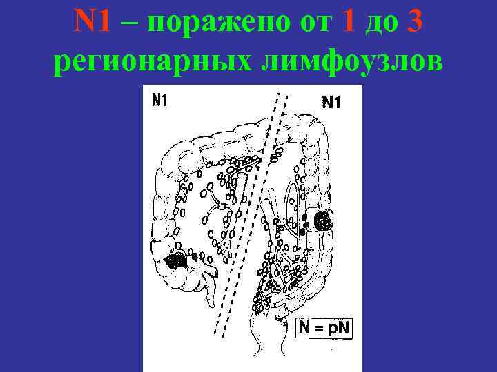 N 1 – поражено от 1 до 3 регионарных лимфоузлов 