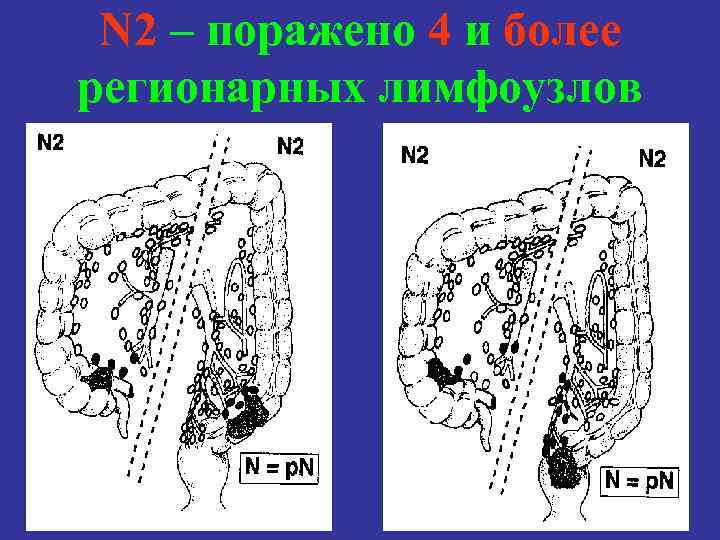 N 2 – поражено 4 и более регионарных лимфоузлов 