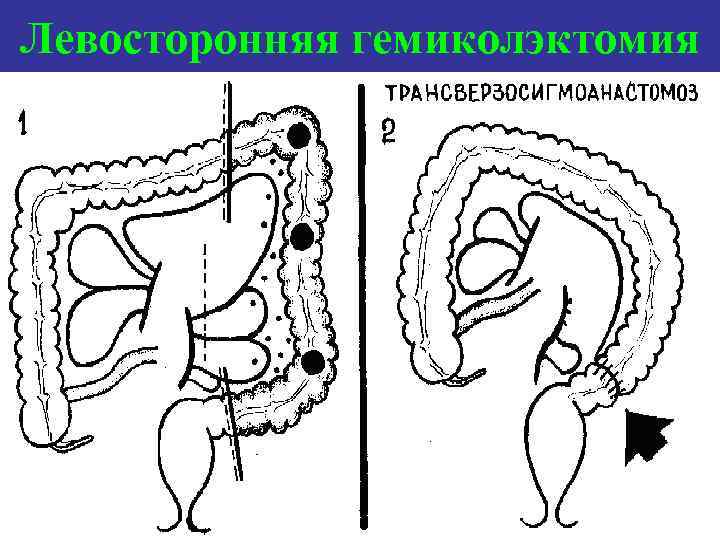 Левосторонняя гемиколэктомия 