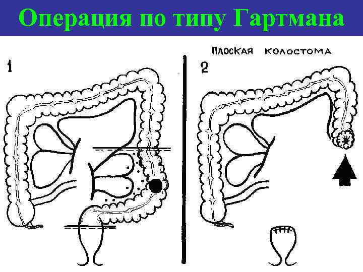 Операция по типу Гартмана 