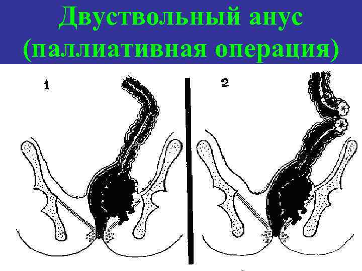 Двуствольный анус (паллиативная операция) 