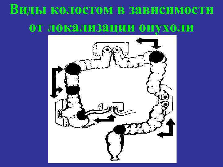 Виды колостом в зависимости от локализации опухоли 