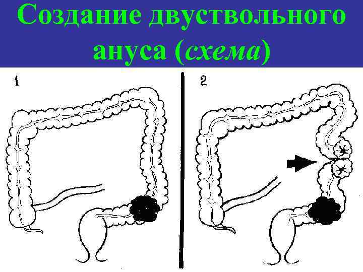 Создание двуствольного ануса (схема) 