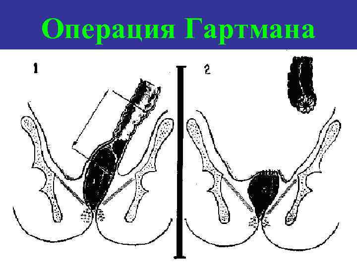 Операция Гартмана 