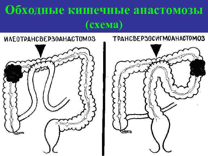 Заболевания прямой и ободочной кишки презентация