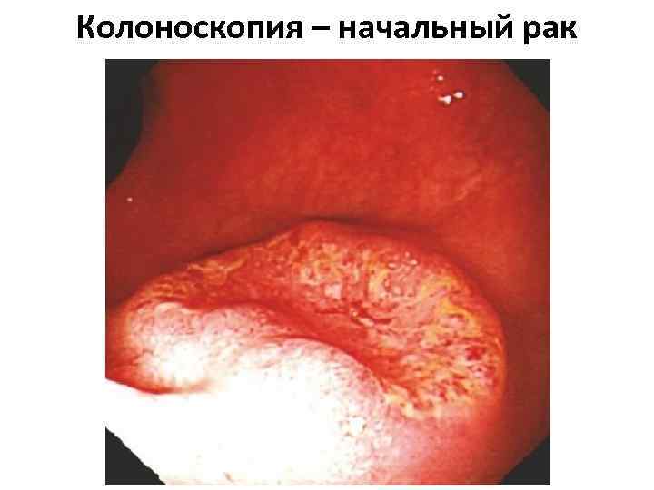 Колоноскопия – начальный рак 