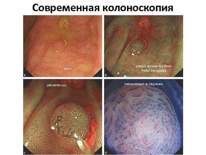 Современная колоноскопия 