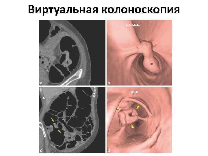 Виртуальная колоноскопия 