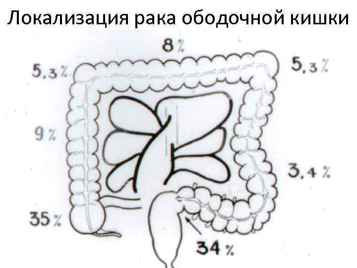 Локализация рака ободочной кишки 