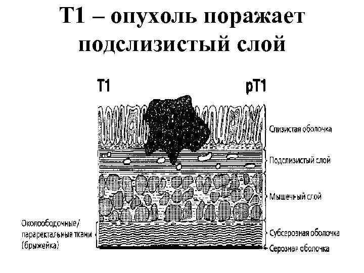 T 1 – опухоль поражает подслизистый слой 