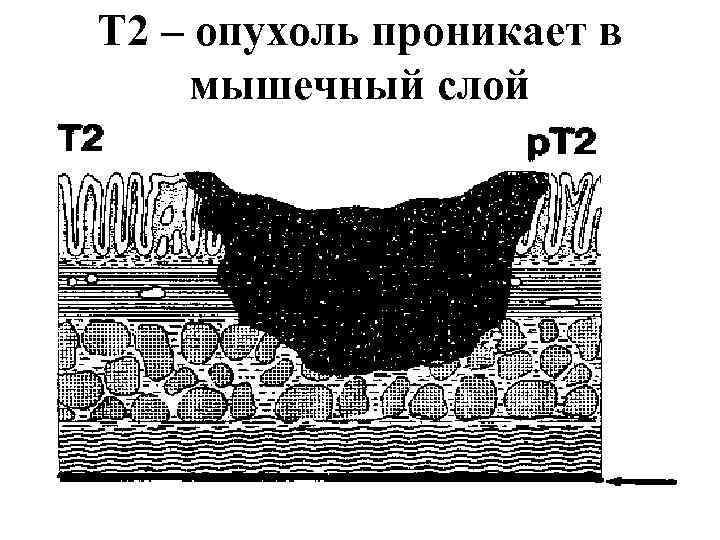 T 2 – опухоль проникает в мышечный слой 