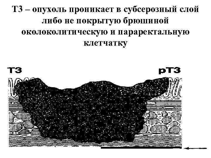 Т 3 – опухоль проникает в субсерозный слой либо не покрытую брюшиной околитическую и