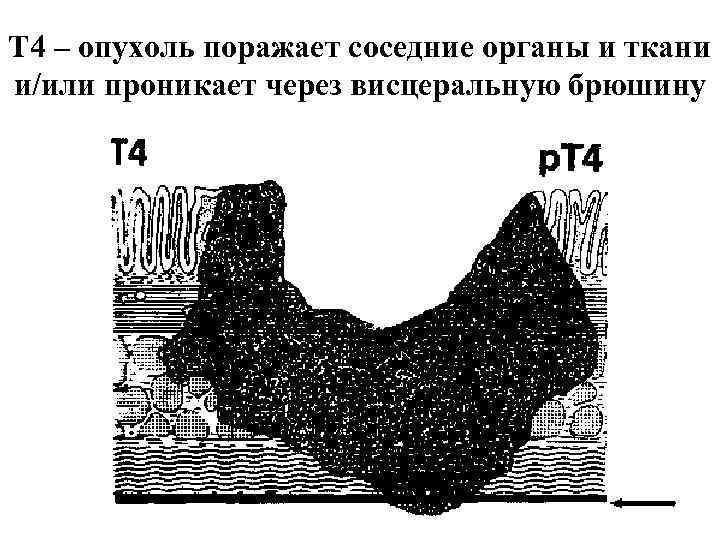 Т 4 – опухоль поражает соседние органы и ткани и/или проникает через висцеральную брюшину